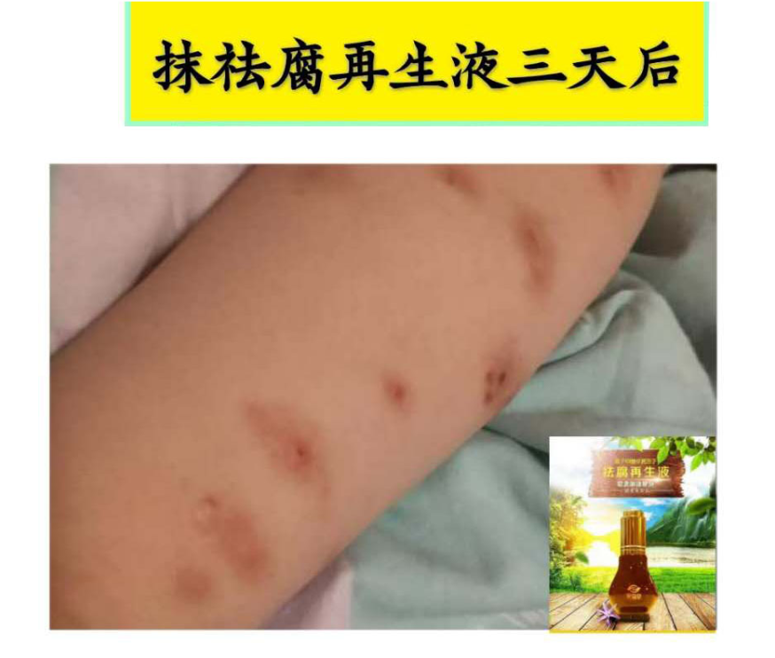 【祛腐再生液】系列反馈【图片】(图33)